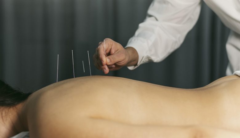 Acupuncture